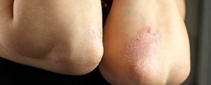 Le CBD est excellent contre le psoriasis